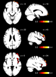 A grid image showing six scans of grey matter in brains. The image is Figure 3 from the article that is linked.