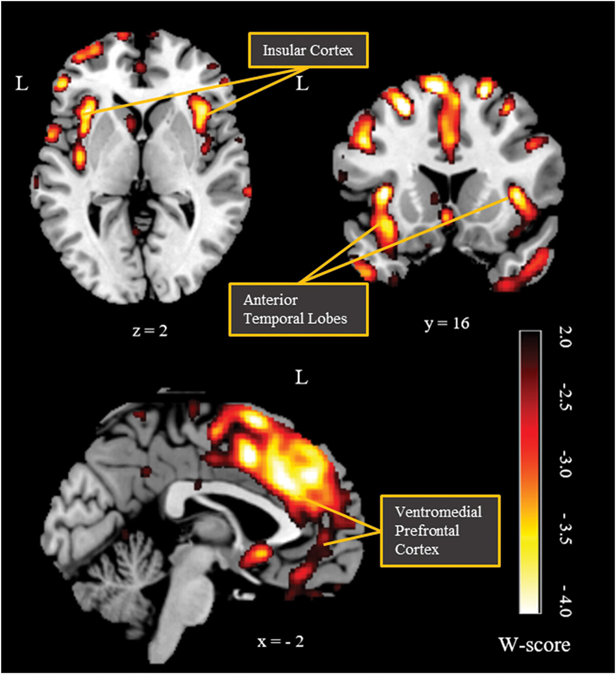 Figure 1. Mr. U’s brain volumes compared to healthy controls.