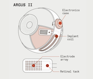Diagram of the Argus II retinal implant, showing its electronics case, implant coil, electrode array, and retinal tack.